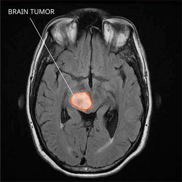 рак головного мозга на МРТ